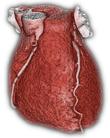 CT Heart