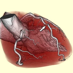 Read more about the article When the diagnostic accuracy of coronary CT angiography matches that of catheter angiography